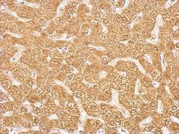 Immunohistochemistry-Paraffin: Cytochrome P450 2C8 Antibody [NBP2-16078] - Antibody detects CYP2C8 protein at cytosol on hepatoma by immunohistochemical analysis. Sample: Paraffin-embedded hepatoma. CYP2C8 antibody dilution: 1:500.