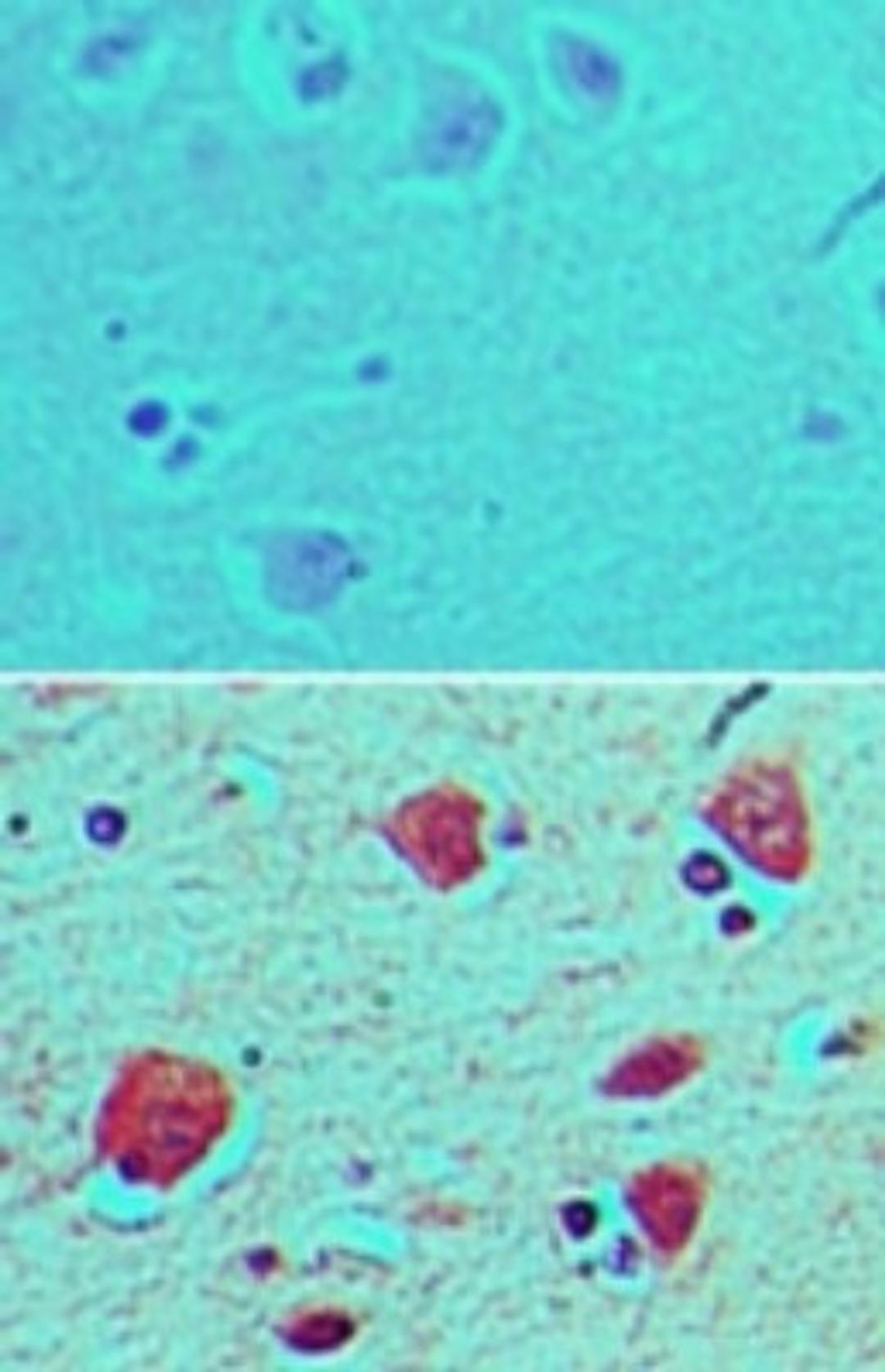 Immunohistochemistry-Paraffin: Bone marrow stromal cell antigen 1 Antibody [NBP2-24581] - analysis of BST1 in formalin-fixed, paraffin-embedded human brain tissue using an isotype control antibody(top) and BST1 antibody (bottom) at 5 ug/ml.