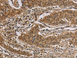 The image is immunohistochemistry of paraffin-embedded Human gastric cancer tissue using CSB-PA984107(CASP3 Antibody) at dilution 1/30. (Original magnification: ×200)
