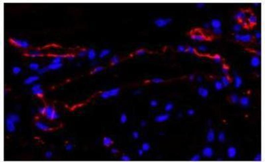 Immunocytochemistry/Immunofluorescence: CD31/PECAM-1 Antibody [NB100-2284] - FFPE section of human breast carcinoma. Antibody: Affinity purified rabbit anti-CD31/PECAM (NB100-2284) used at a dilution of 1:100.  Detection: Red-fluorescent goat anti-rabbit IgG-Hilyte PlusTM 555