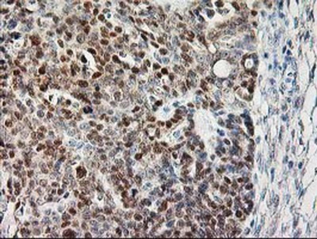 Immunohistochemistry-Paraffin: Calpain 9 Antibody (3G10) [NBP2-01305] - Staining of paraffin-embedded Adenocarcinoma of Human ovary tissue using anti-Calpain 9 mouse monoclonal antibody.