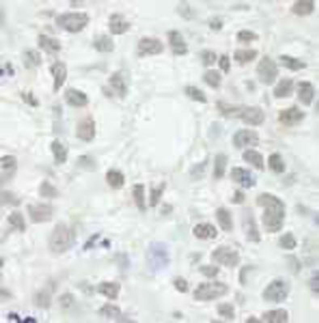 Immunohistochemistry-Paraffin: MED12 Antibody [NB100-2357] - FFPE section of human breast adenocarcinoma.  Affinity purified rabbit anti-MED12 used at a dilution of 1:250.