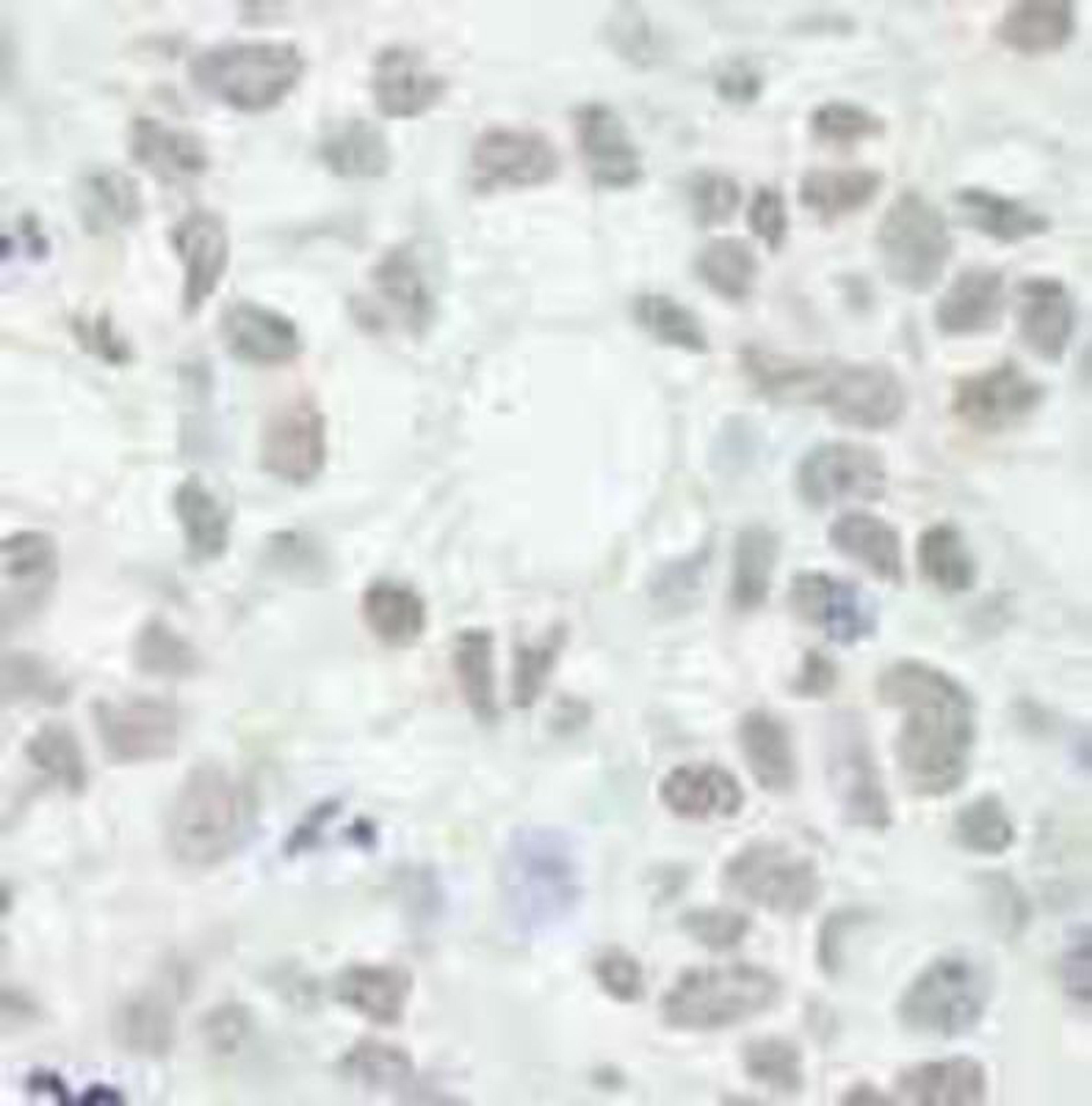 Immunohistochemistry-Paraffin: MED12 Antibody [NB100-2357] - FFPE section of human breast adenocarcinoma.  Affinity purified rabbit anti-MED12 used at a dilution of 1:250.