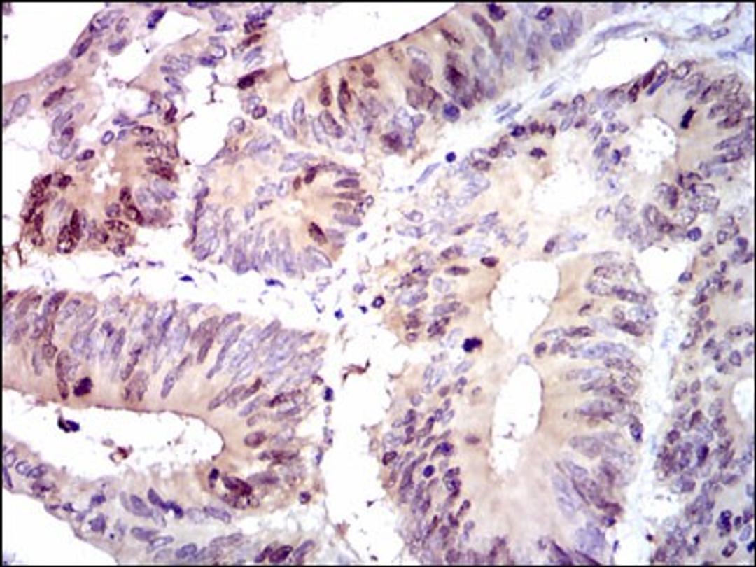 Immunohistochemistry: PBK Antibody (2C8) [NBP2-37514] - Immunohistochemical analysis of paraffin-embedded colon cancer tissues using PBK mouse mAb with DAB staining.