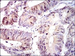 Immunohistochemistry: PBK Antibody (2C8) [NBP2-37514] - Immunohistochemical analysis of paraffin-embedded colon cancer tissues using PBK mouse mAb with DAB staining.