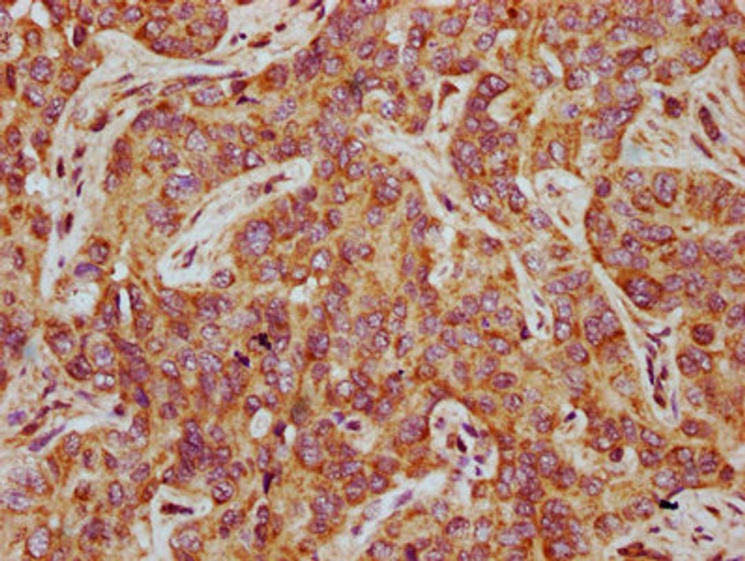 IHC image of CSB-PA822176LA01HU diluted at 1:500 and staining in paraffin-embedded human liver cancer performed on a Leica BondTM system. After dewaxing and hydration, antigen retrieval was mediated by high pressure in a citrate buffer (pH 6.0). Section was blocked with 10% normal goat serum 30min at RT. Then primary antibody (1% BSA) was incubated at 4°C overnight. The primary is detected by a biotinylated secondary antibody and visualized using an HRP conjugated SP system.