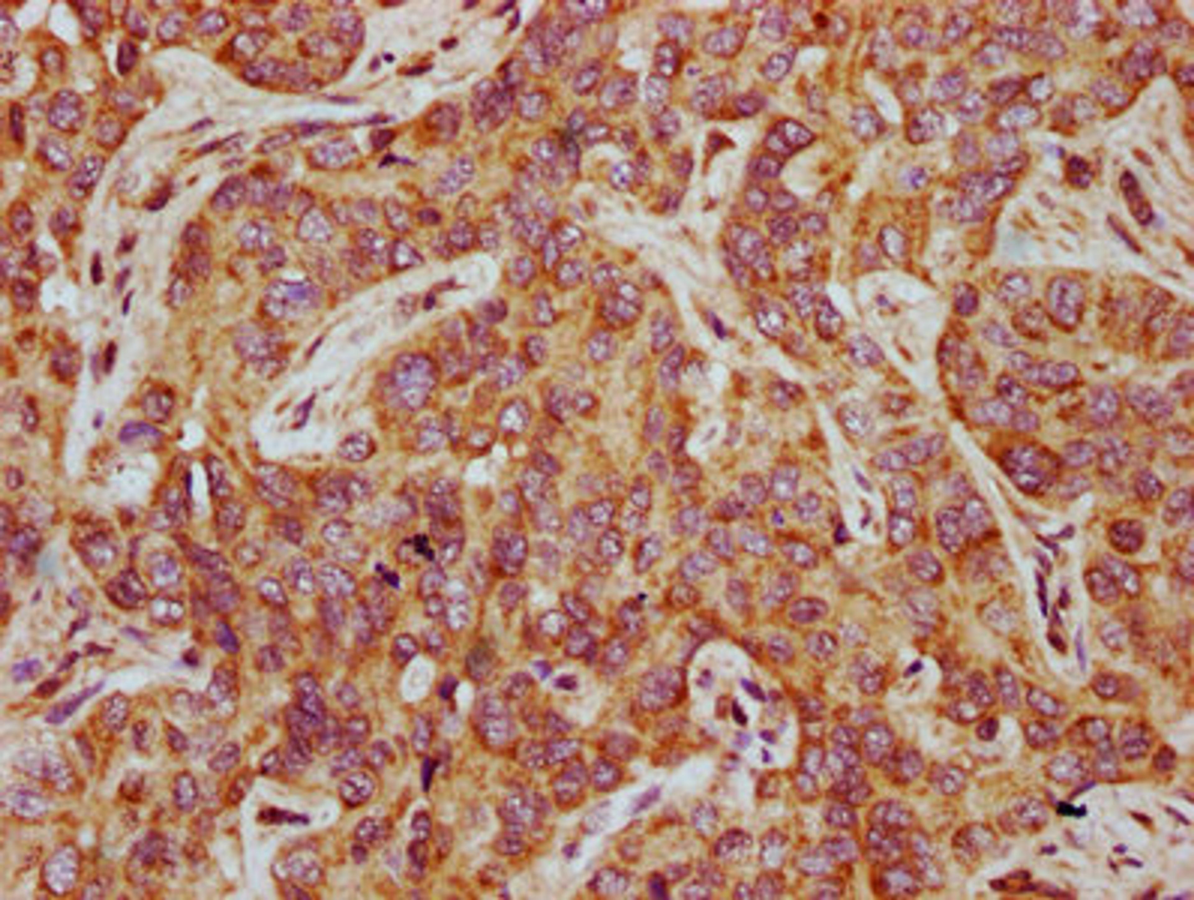 IHC image of CSB-PA822176LA01HU diluted at 1:500 and staining in paraffin-embedded human liver cancer performed on a Leica BondTM system. After dewaxing and hydration, antigen retrieval was mediated by high pressure in a citrate buffer (pH 6.0). Section was blocked with 10% normal goat serum 30min at RT. Then primary antibody (1% BSA) was incubated at 4°C overnight. The primary is detected by a biotinylated secondary antibody and visualized using an HRP conjugated SP system.