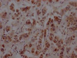 IHC image of CSB-RA986790A0HU diluted at 1:100 and staining in paraffin-embedded human breast cancer performed on a Leica BondTM system. After dewaxing and hydration, antigen retrieval was mediated by high pressure in a citrate buffer (pH 6.0). Section was blocked with 10% normal goat serum 30min at RT. Then primary antibody (1% BSA) was incubated at 4℃ overnight. The primary is detected by a Goat anti-rabbit IgG polymer labeled by HRP and visualized using 0.05% DAB.