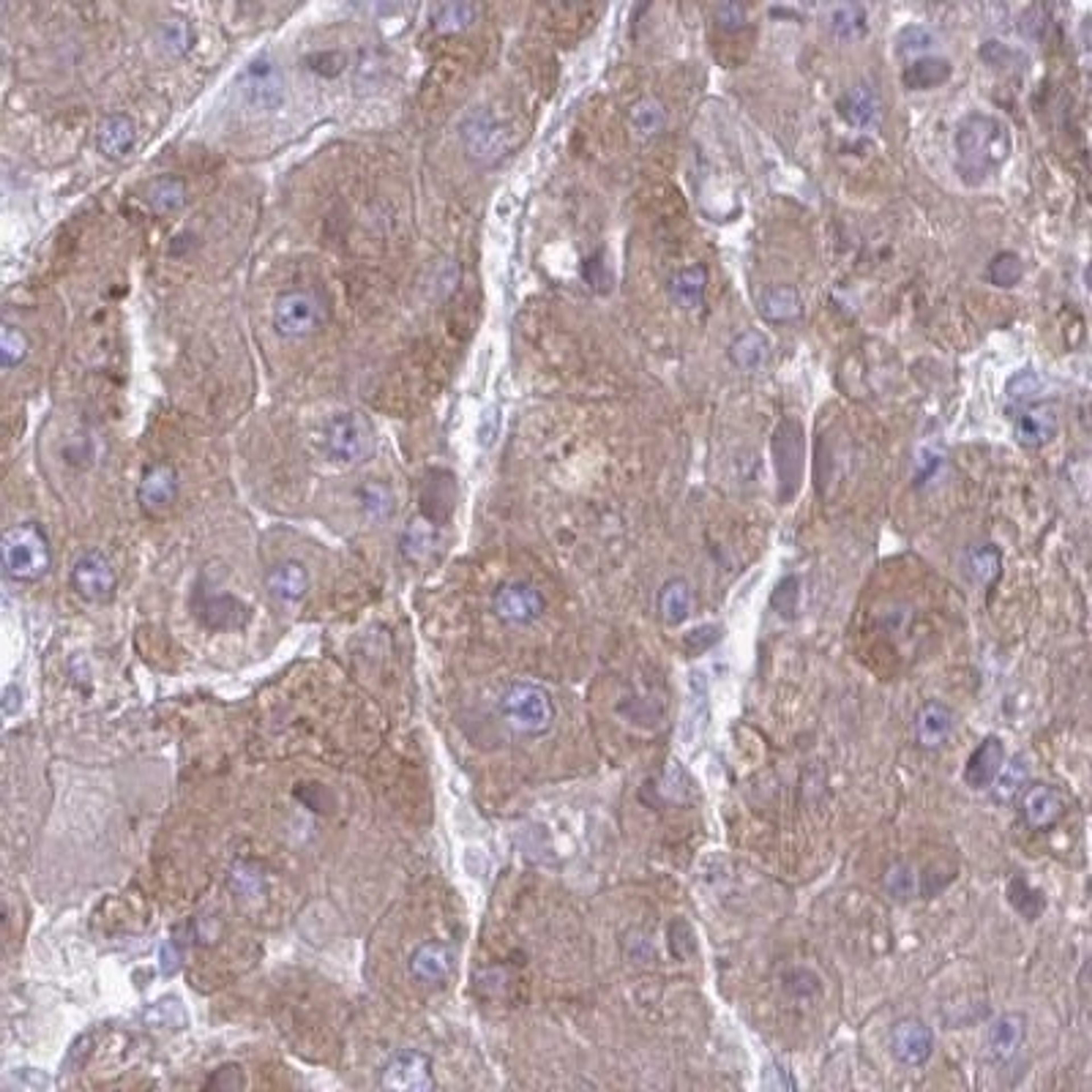 Immunohistochemistry: SC4MOL Antibody [NBP2-31624] - liver cancer