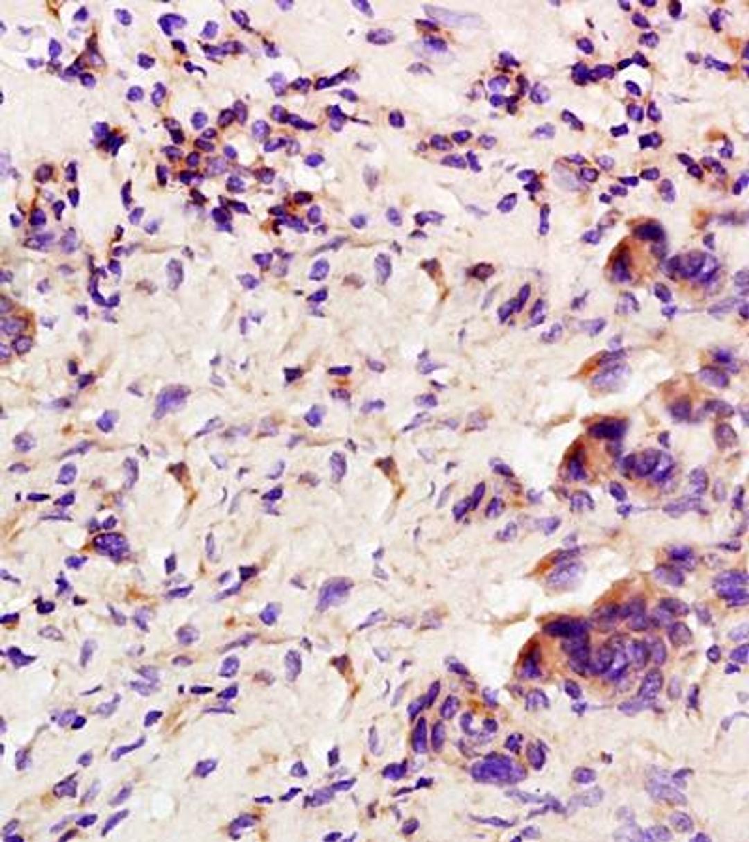 Immunohistochemical analysis of formalin fixed and paraffin embedded human rectal carcinoma using GCSF antibody