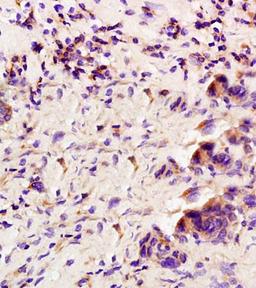 Immunohistochemical analysis of formalin fixed and paraffin embedded human rectal carcinoma using GCSF antibody