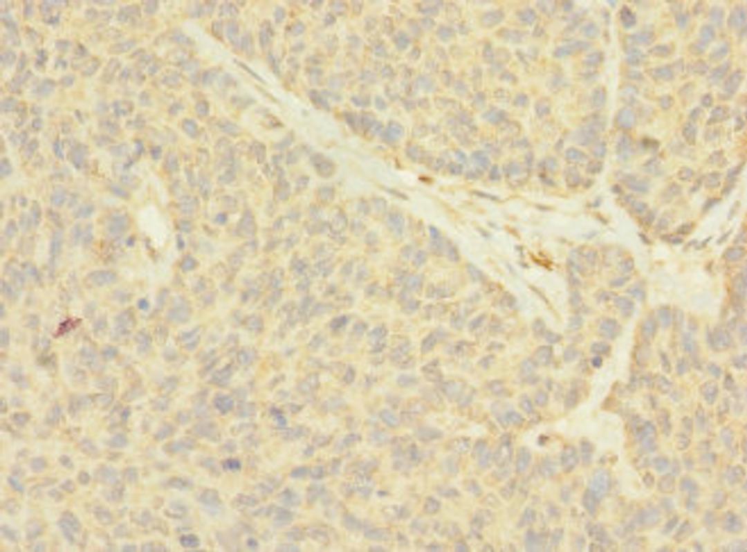 Immunohistochemistry of paraffin-embedded human ovarian cancer using CSB-PA015437LA01HU at dilution of 1:100