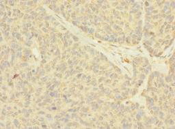 Immunohistochemistry of paraffin-embedded human ovarian cancer using CSB-PA015437LA01HU at dilution of 1:100