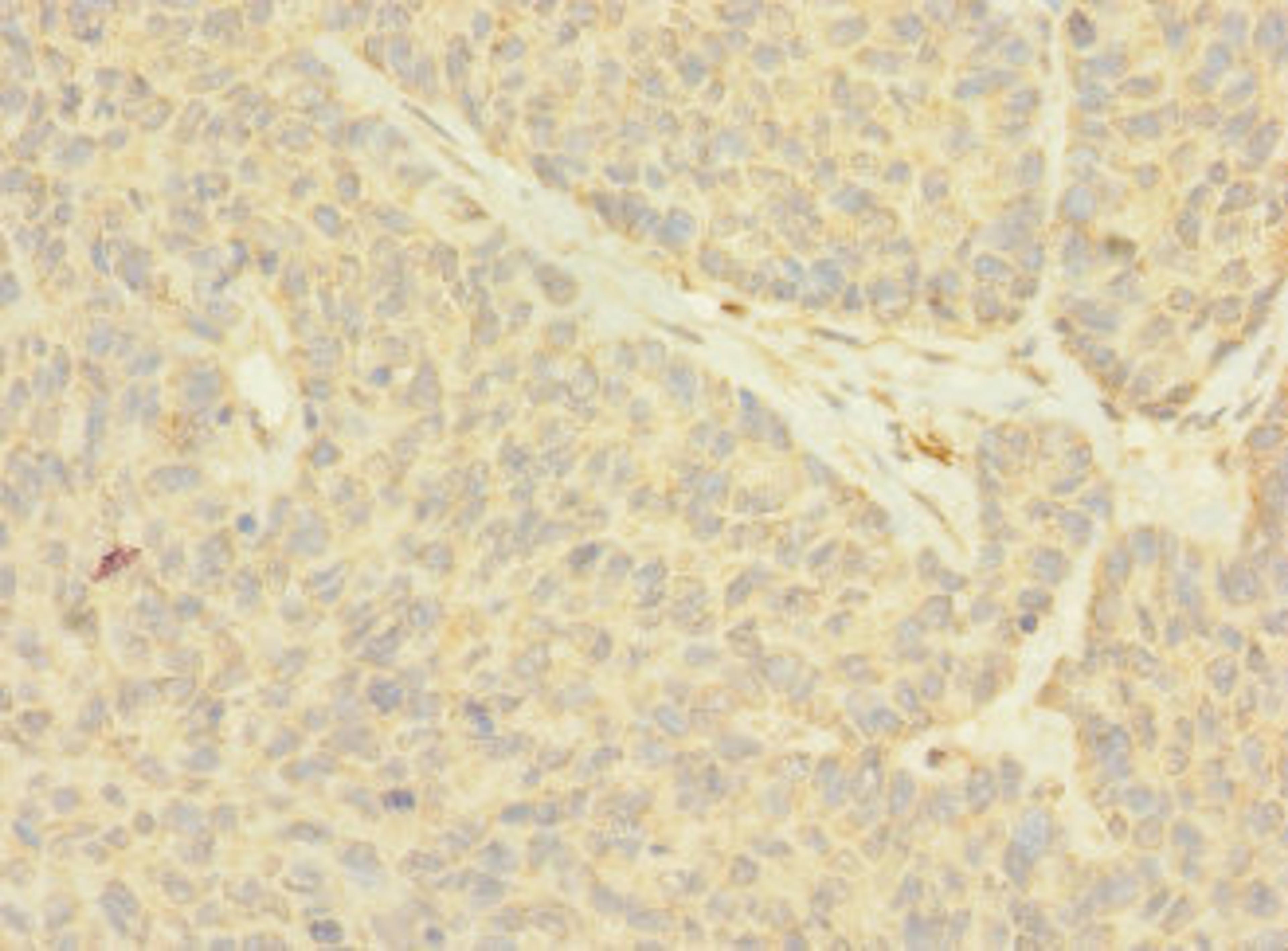 Immunohistochemistry of paraffin-embedded human ovarian cancer using CSB-PA015437LA01HU at dilution of 1:100