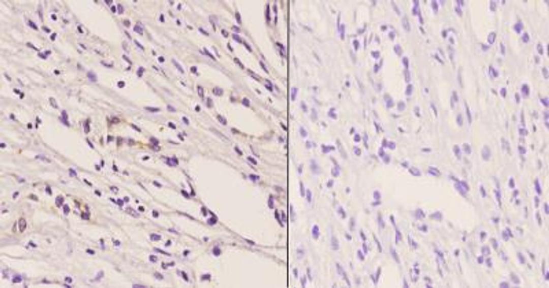 Immunohistochemistry-Paraffin: TrkB [p Tyr706] Antibody [NB100-92657] - Analyzes of TrkB [p Tyr706] pAb in paraffin-embedded human kidney carcinoma tissue at 1:50. Showing cytoplasmic staining.  Negative control (the right) Using PBS instead of primary antibody.