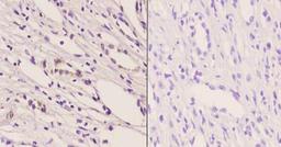 Immunohistochemistry-Paraffin: TrkB [p Tyr706] Antibody [NB100-92657] - Analyzes of TrkB [p Tyr706] pAb in paraffin-embedded human kidney carcinoma tissue at 1:50. Showing cytoplasmic staining.  Negative control (the right) Using PBS instead of primary antibody.