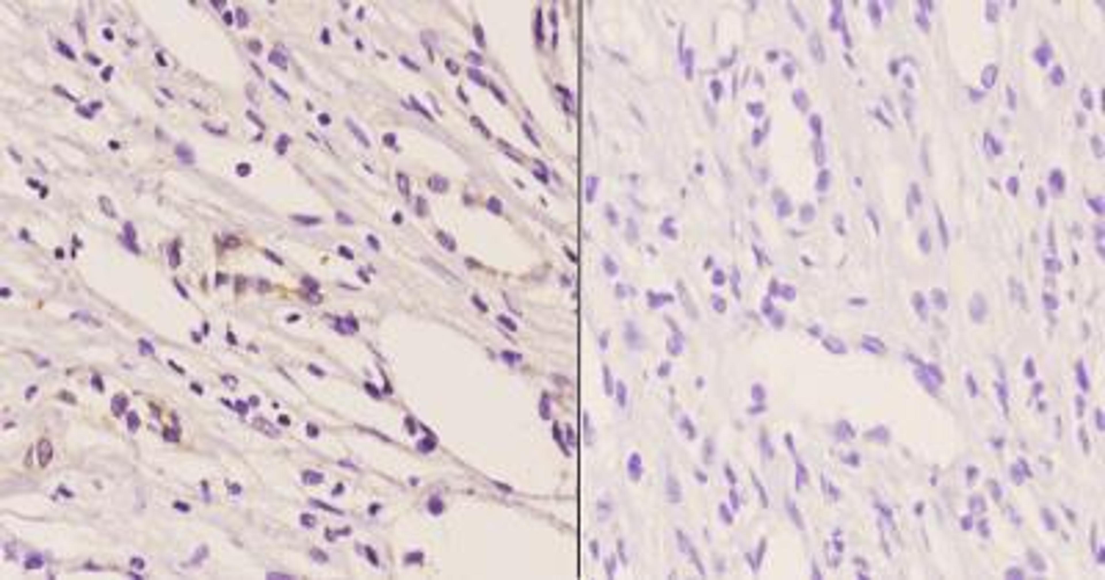 Immunohistochemistry-Paraffin: TrkB [p Tyr706] Antibody [NB100-92657] - Analyzes of TrkB [p Tyr706] pAb in paraffin-embedded human kidney carcinoma tissue at 1:50. Showing cytoplasmic staining.  Negative control (the right) Using PBS instead of primary antibody.