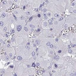 Immunohistochemistry: SLC30A6 Antibody [NBP2-31673] - liver cancer