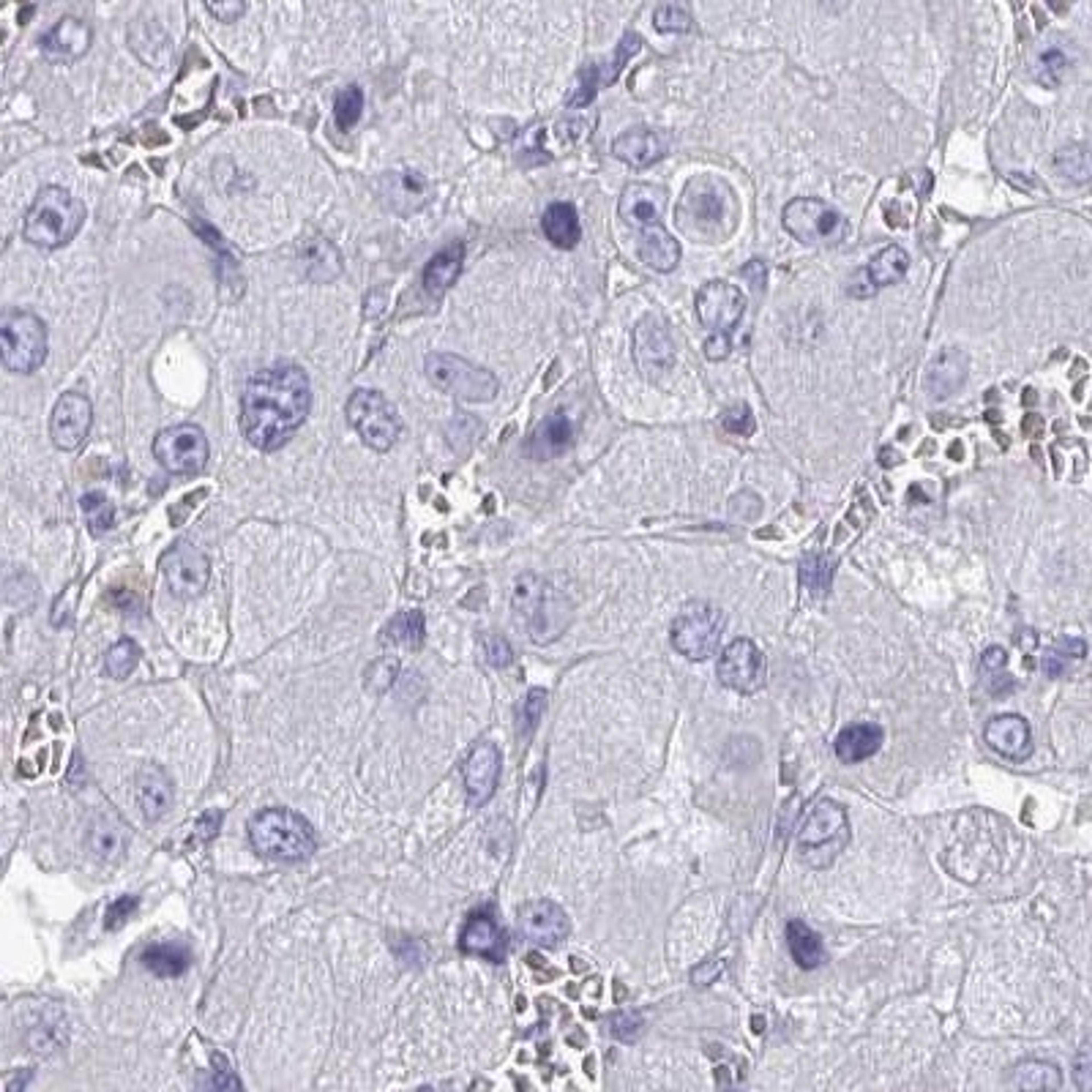 Immunohistochemistry: SLC30A6 Antibody [NBP2-31673] - liver cancer