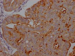 IHC image of CSB-RA941216A0HU diluted at 1:100 and staining in paraffin-embedded human endometrial cancer performed on a Leica BondTM system. After dewaxing and hydration, antigen retrieval was mediated by high pressure in a citrate buffer (pH 6.0). Section was blocked with 10% normal goat serum 30min at RT. Then primary antibody (1% BSA) was incubated at 4℃ overnight. The primary is detected by a Goat anti-rabbit IgG polymer labeled by HRP and visualized using 0.05% DAB.