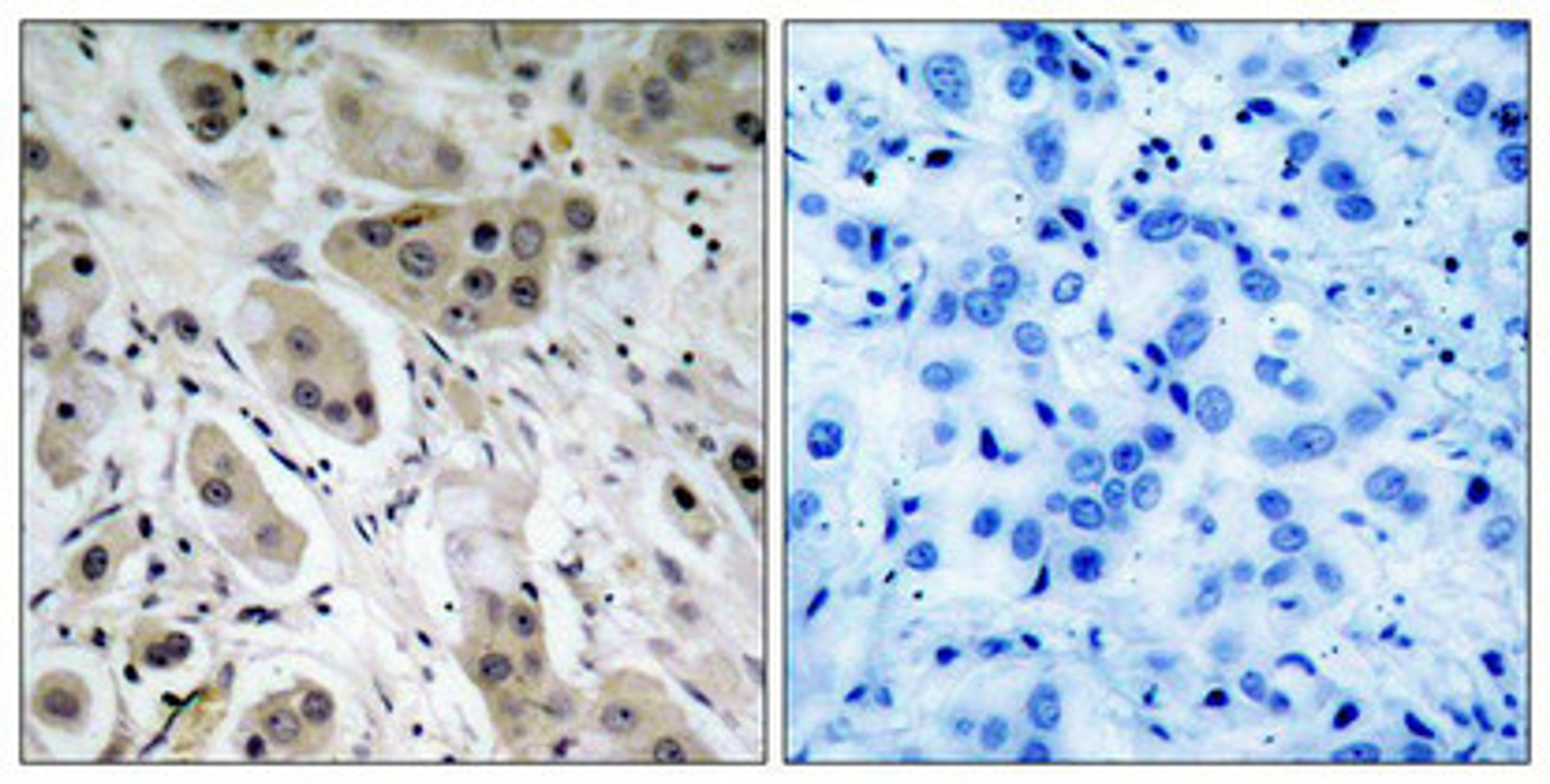 Immunohistochemical analysis of paraffin-embedded human breast carcinoma tissue using Akt(Phospho-Ser473) Antibody(left) or the same antibody preincubated with blocking peptide(right).