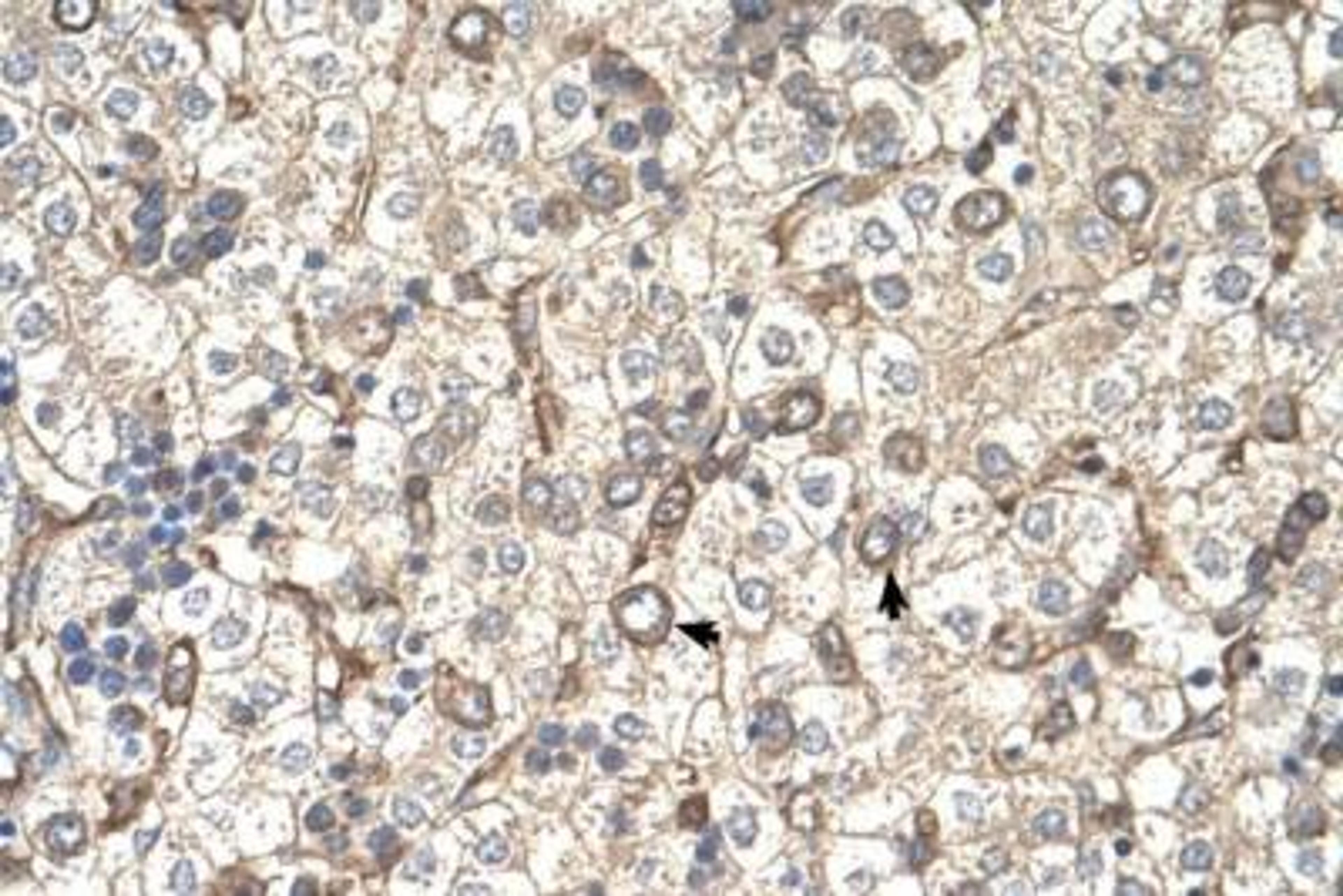 Immunohistochemistry: ST3GAL4 Antibody [NBP1-69565] - Human Liver cells.