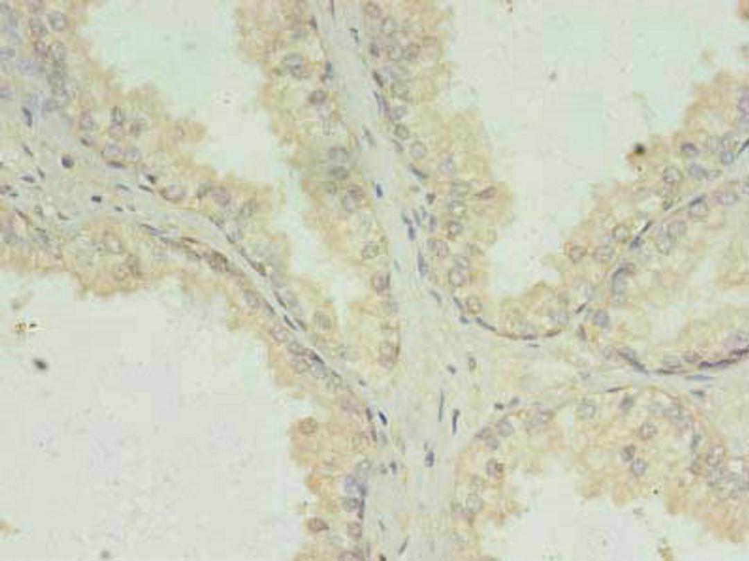 Immunohistochemistry of paraffin-embedded human prostate cancer using CSB-PA13669A0Rb at dilution of 1:100