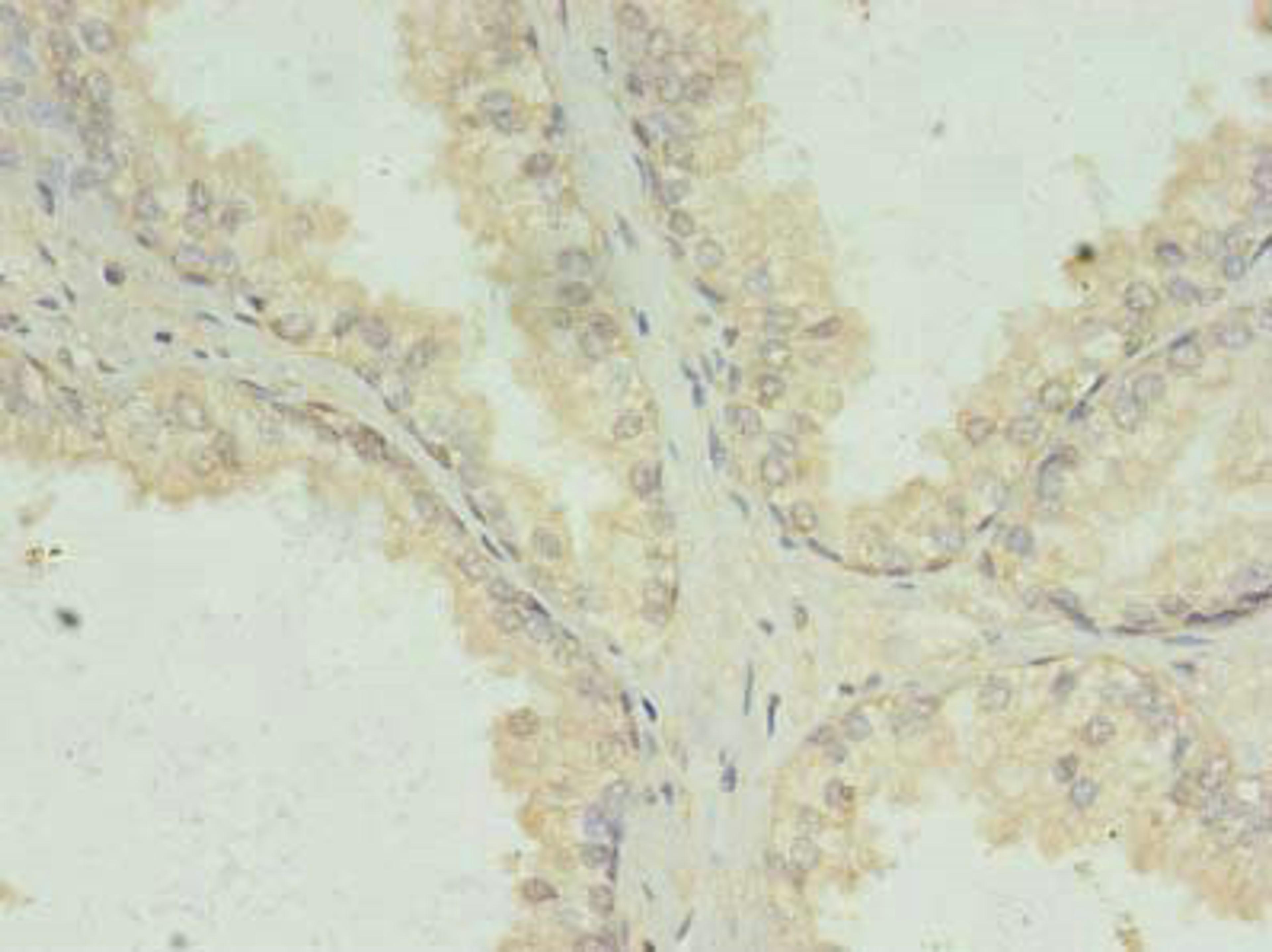 Immunohistochemistry of paraffin-embedded human prostate cancer using CSB-PA13669A0Rb at dilution of 1:100