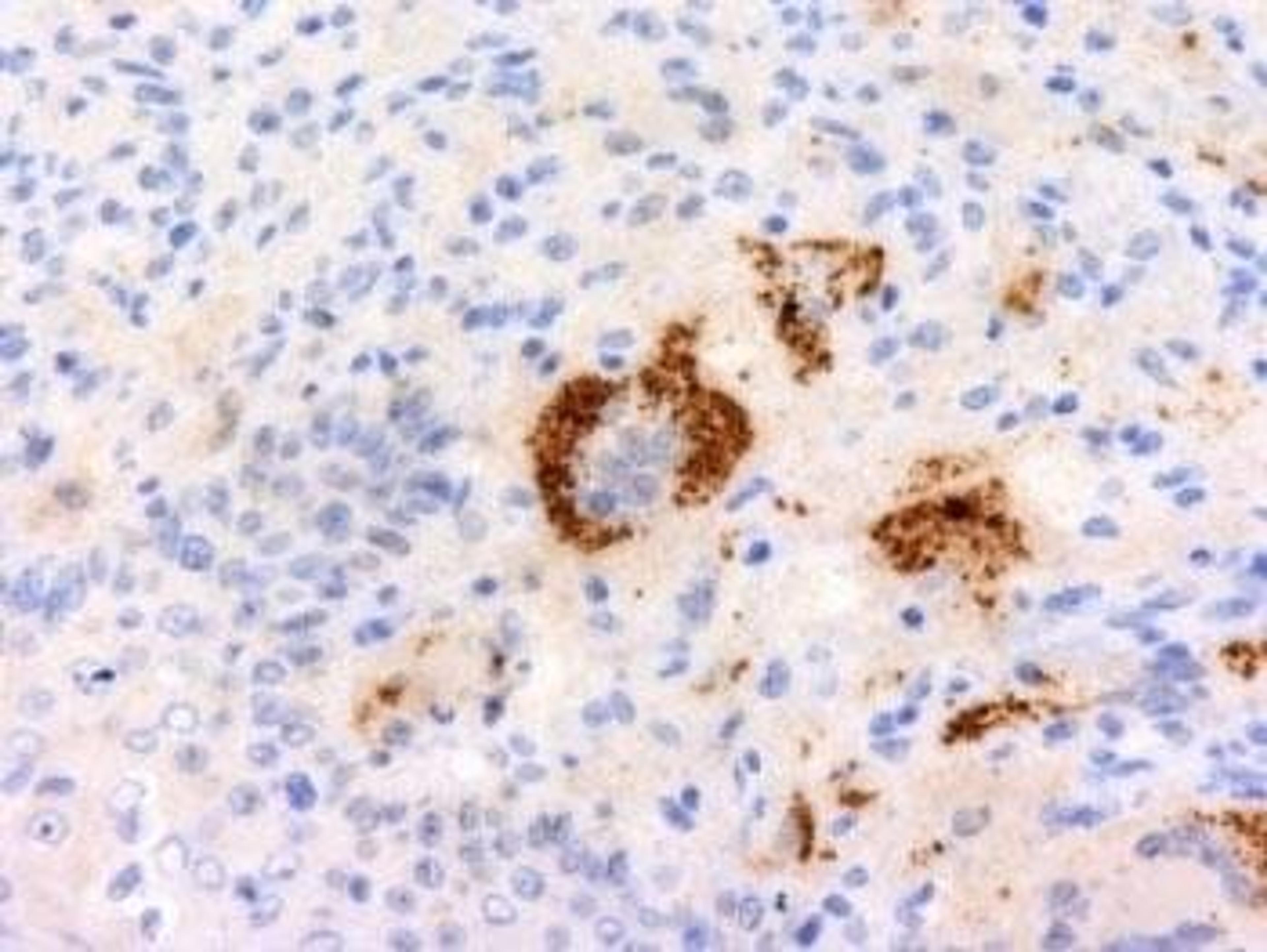 Immunohistochemical staining of Human Erdheim Chester disease using TNF-a antibody