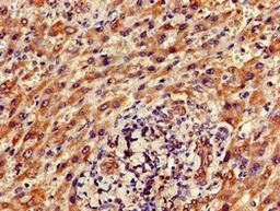 Immunohistochemistry of paraffin-embedded human liver cancer using CSB-PA853484LA01HU at dilution of 1:100