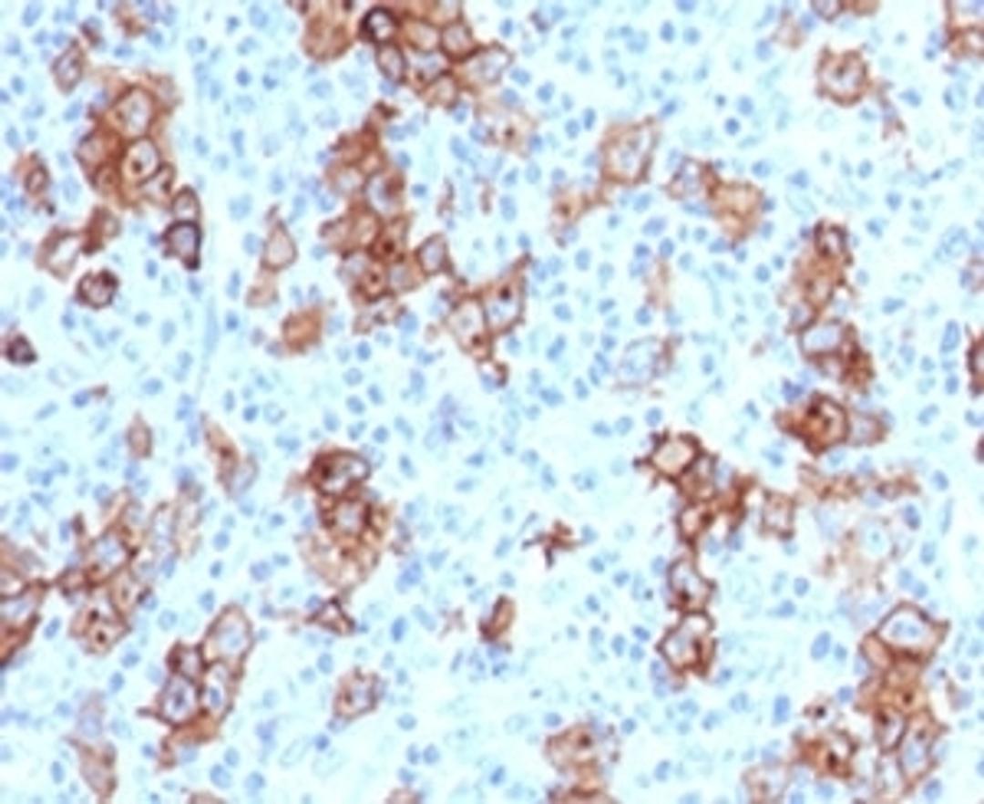 IHC testing of FFPE human Hodgkin's lymphoma and CD30 antibody (CDLA30-1).