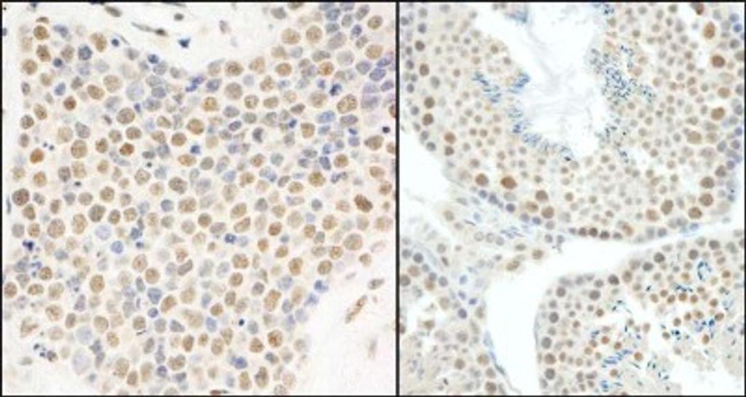 Immunohistochemistry-Paraffin: HNRNPUL1 Antibody [NB110-40586] - Human small cell lung cancer (left) and mouse testis (right).  Antibody used at a dilution of 1:200.