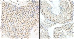 Immunohistochemistry-Paraffin: HNRNPUL1 Antibody [NB110-40586] - Human small cell lung cancer (left) and mouse testis (right).  Antibody used at a dilution of 1:200.