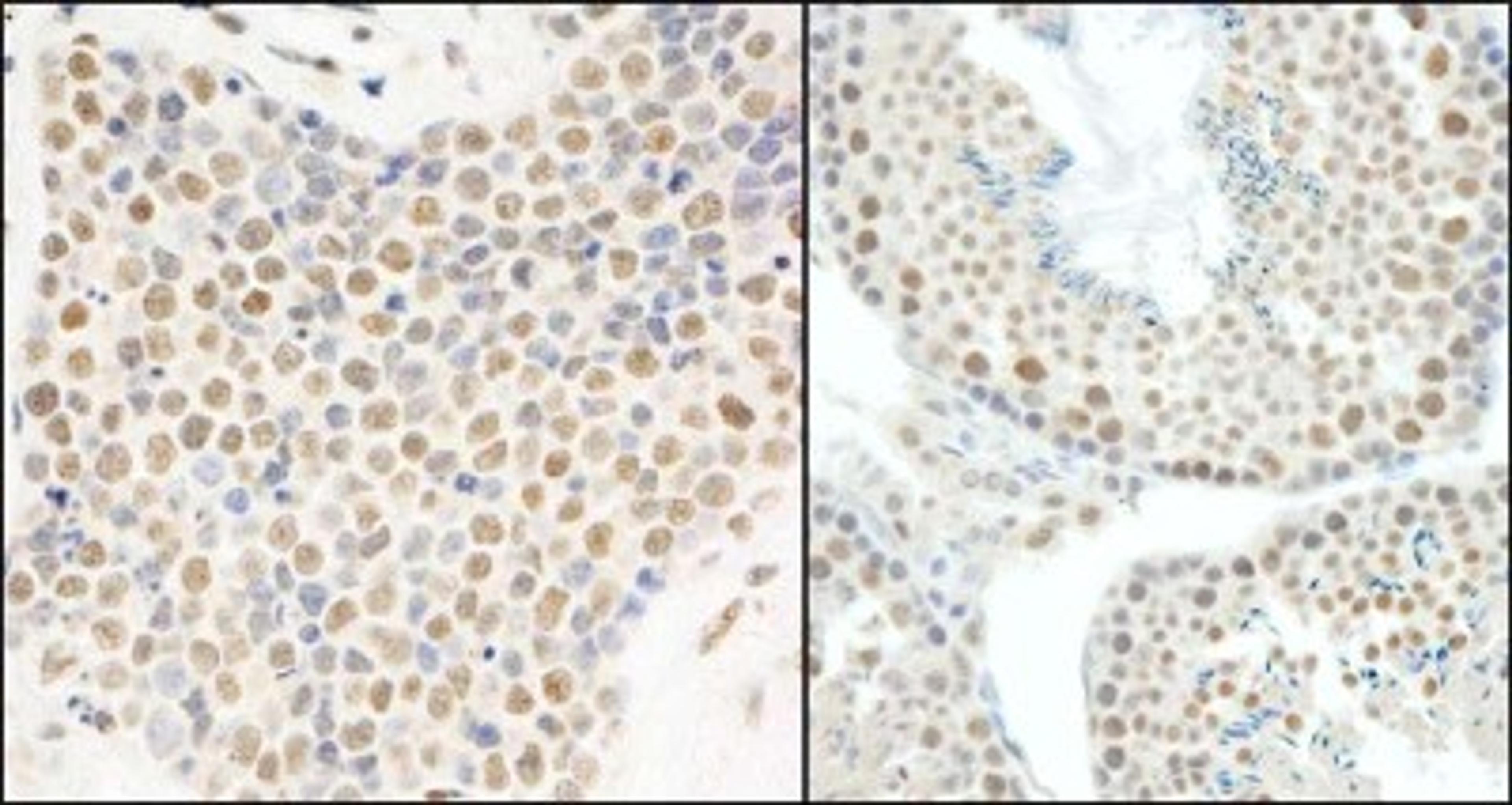 Immunohistochemistry-Paraffin: HNRNPUL1 Antibody [NB110-40586] - Human small cell lung cancer (left) and mouse testis (right).  Antibody used at a dilution of 1:200.