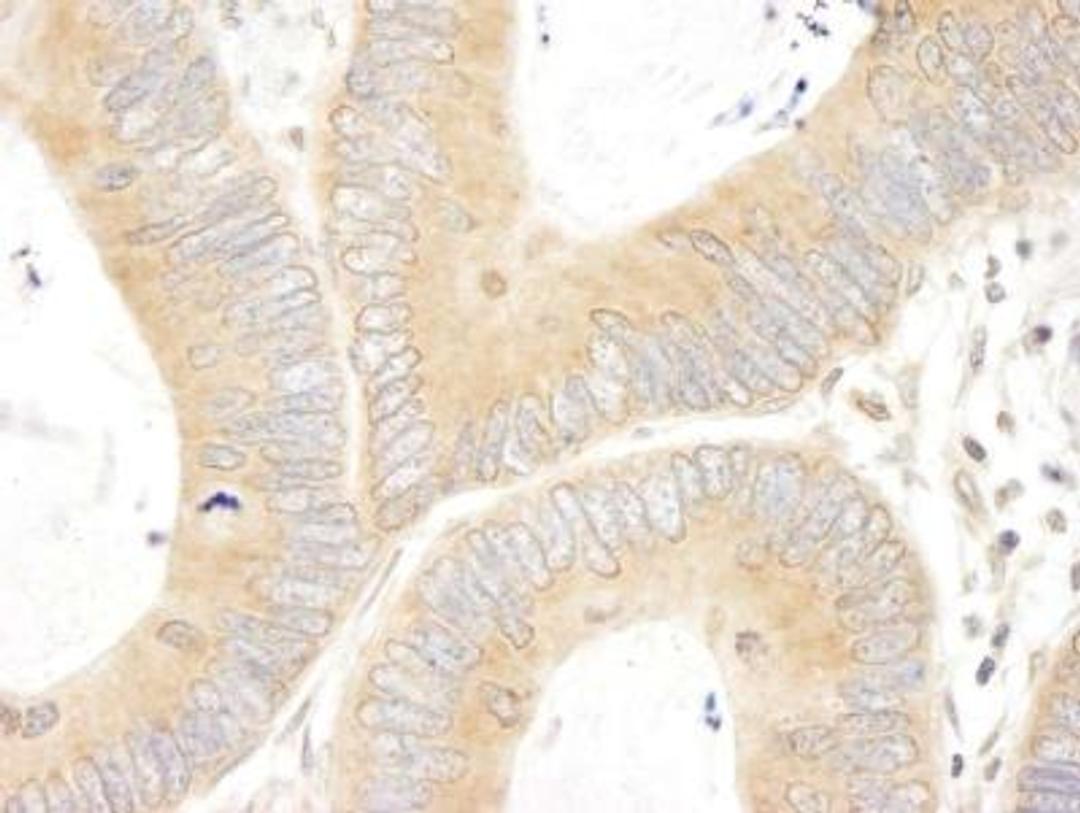 Immunohistochemistry-Paraffin: ABCF1 Antibody [NBP1-18888] - Human colon carcinoma. Antibody used at a dilution of 1:200 (1ug/ml).