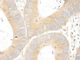 Immunohistochemistry-Paraffin: ABCF1 Antibody [NBP1-18888] - Human colon carcinoma. Antibody used at a dilution of 1:200 (1ug/ml).