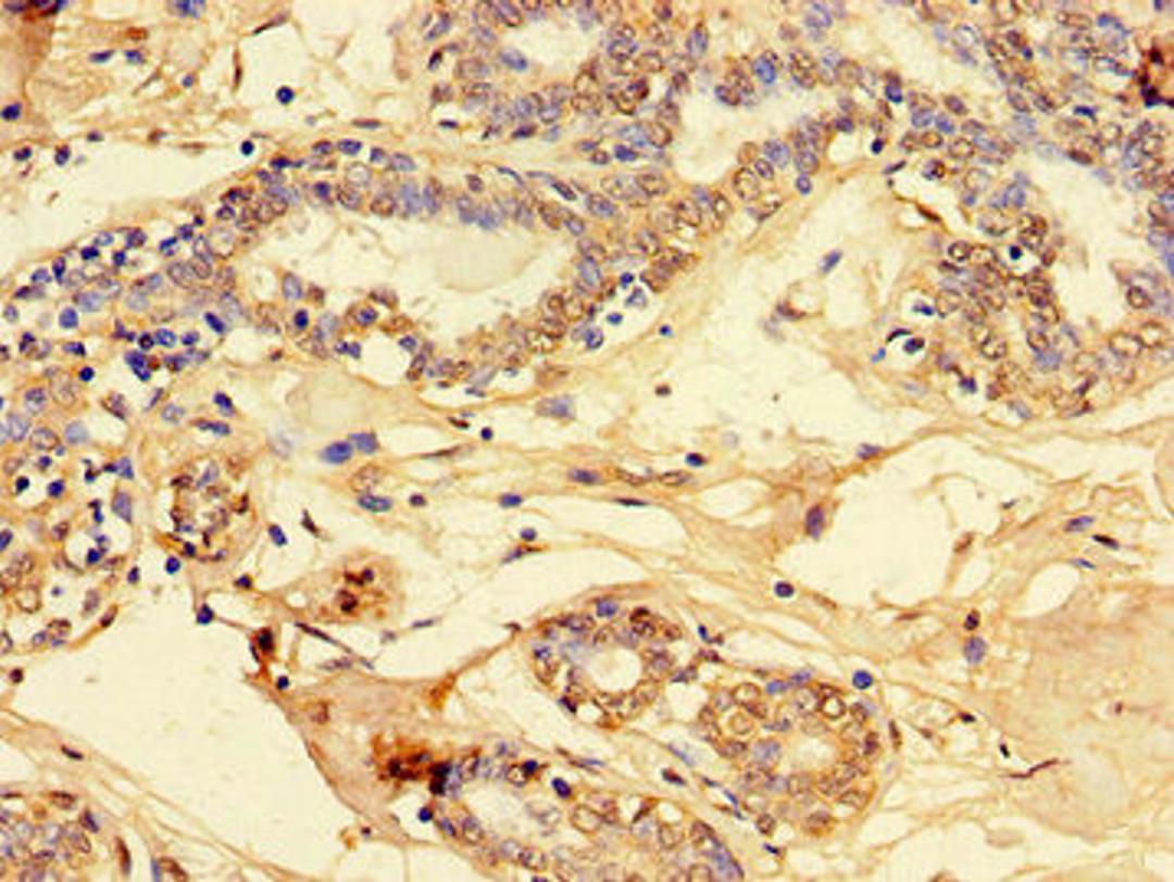 Immunohistochemistry of paraffin-embedded human breast cancer using CSB-PA319771LA01HU at dilution of 1:100