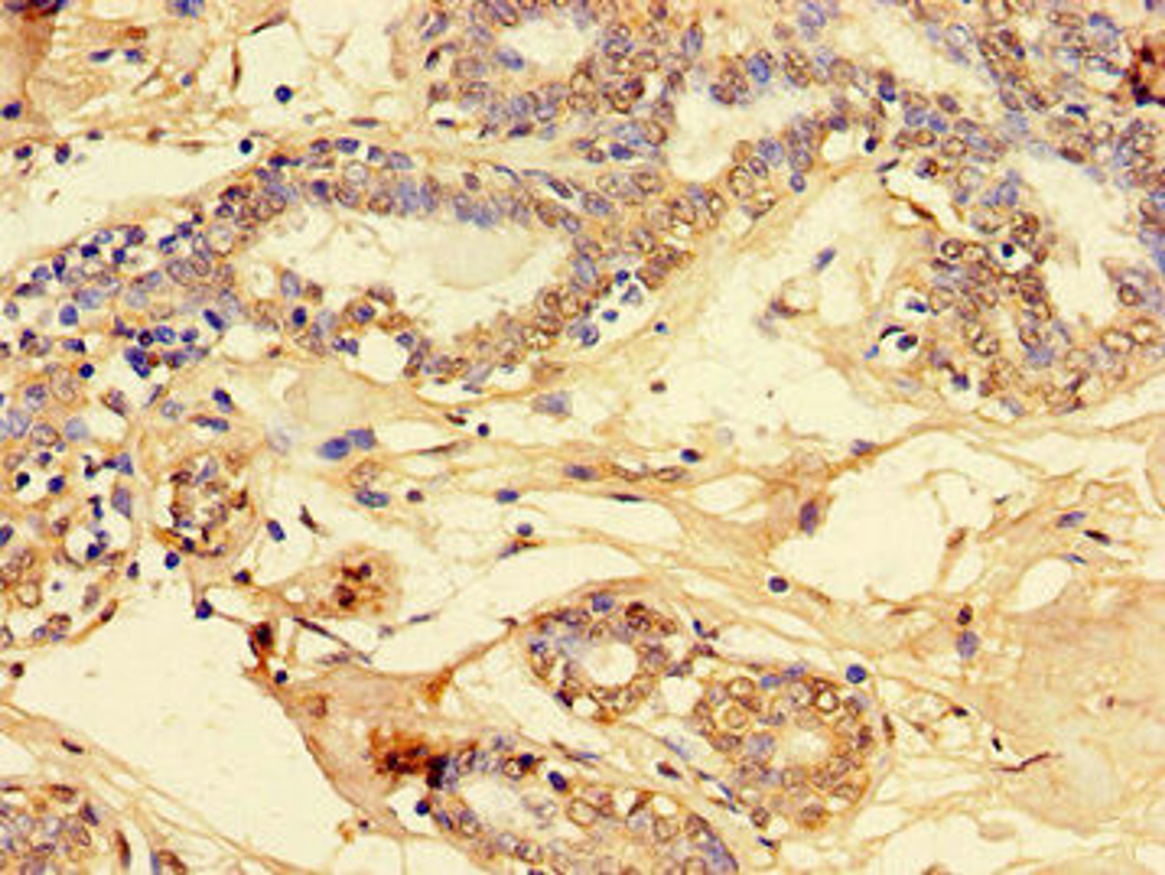 Immunohistochemistry of paraffin-embedded human breast cancer using CSB-PA319771LA01HU at dilution of 1:100