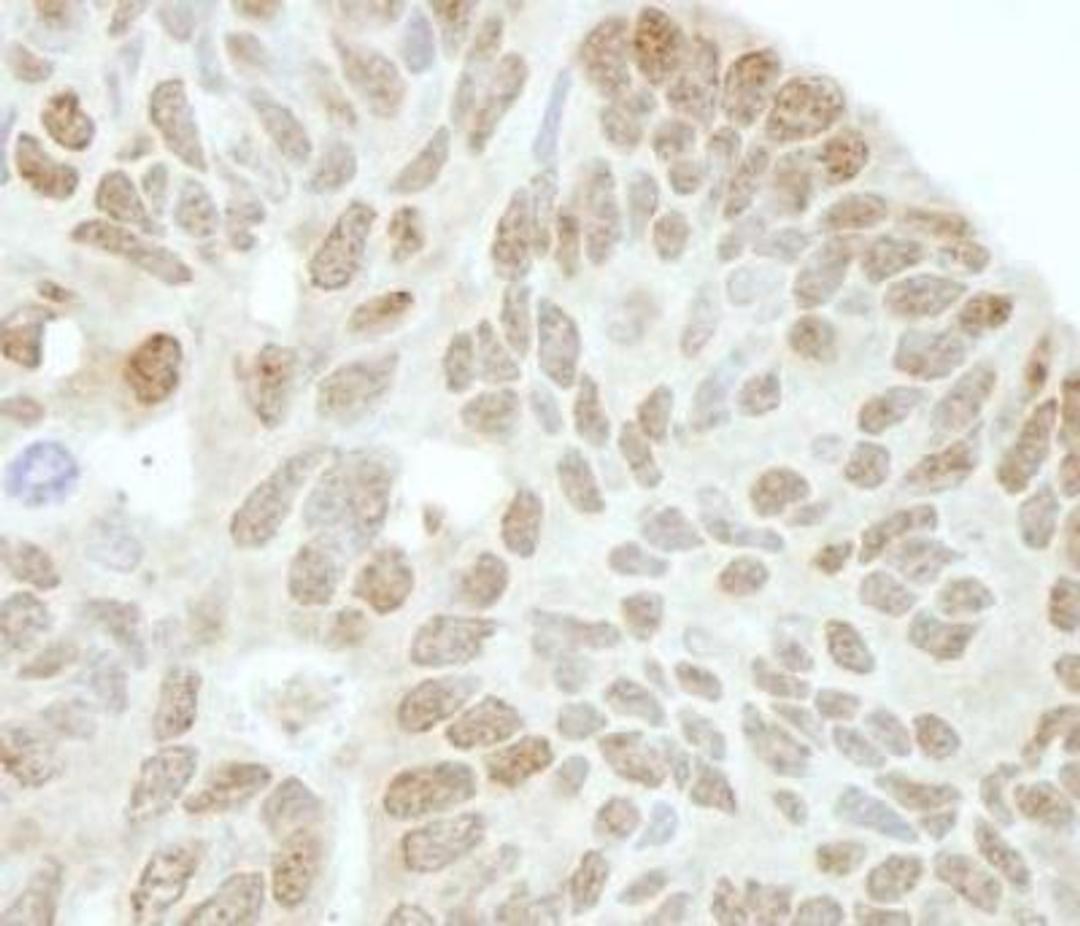 Immunohistochemistry-Paraffin: Drosha Antibody [NBP1-03349] - FFPE human ovarian tumor.  Affinity purified rabbit anti-Drosha 1:250.