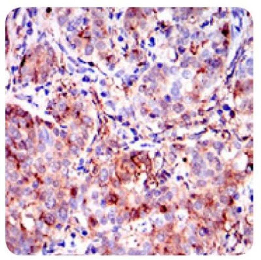 Immunohistochemistry: Annexin A1 Antibody (2F1) [NBP2-23485] - IHC analysis of paraffin embedded human cervical cancer tissues with DAB staining.