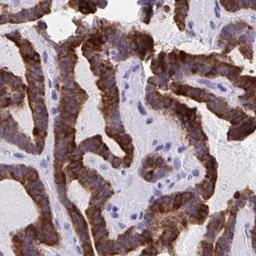 Immunohistochemistry: IYD Antibody [NBP2-31786] - thyroid cancer