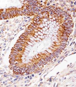 Immunohistochemical analysis of paraffin-embedded H. colorectal carcinoma section using ICT1 Antibody . Antibody was diluted at 1:25 dilution. A undiluted biotinylated goat polyvalent antibody was used as the secondary, followed by DAB staining.