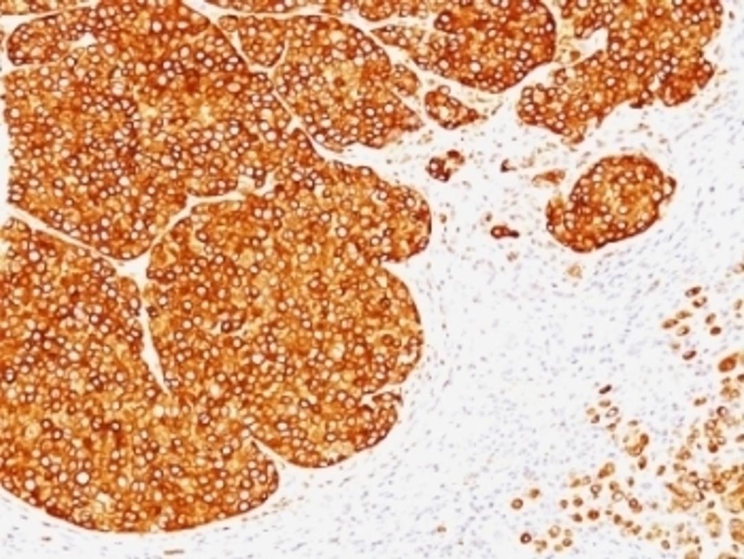 Formalin-fixed, paraffin-embedded human melanoma stained with Tyrosinase antibody (SPM360).