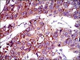 Immunohistochemistry: FATP2/SLC27A2 Antibody (6B3A9) [NBP2-37738] - Immunohistochemical analysis of paraffin-embedded esophageal cancer tissues using SLC27A2 mouse mAb with DAB staining.