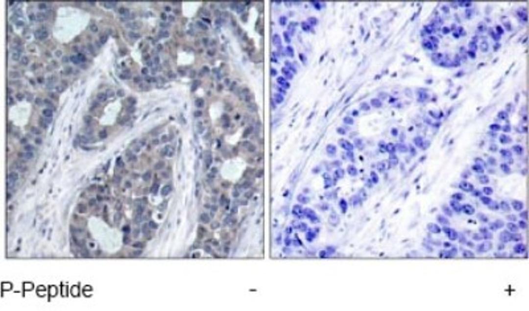 Immunohistochemistry: IRS1 [p Ser636] Antibody [NB100-82003] - Immunohistochemical analysis of paraffin-embedded human breast carcinoma tissue, using IRS-1 (phospho- Ser636) antibody