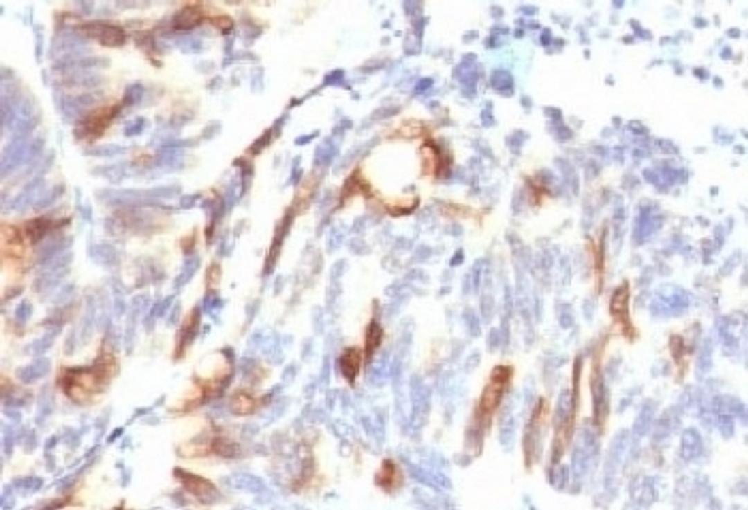 Formalin-fixed, paraffin-embedded human colon carcinoma stained with Mucin-2 antibody (SPM513).