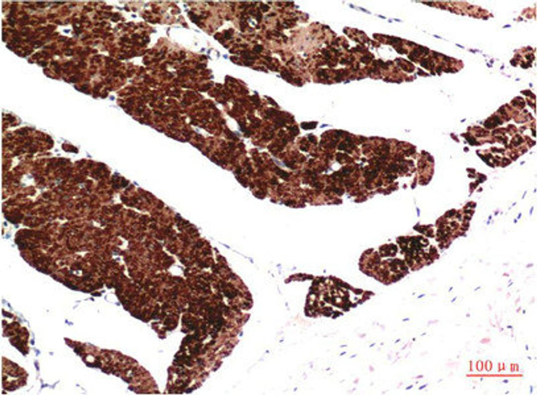 Immunohistochemical analysis of paraffin-embedded Human Colon Carcinoma Tissue using Muscle Actin Mouse mAb diluted at 1:200.