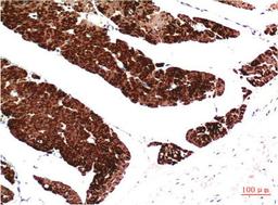 Immunohistochemical analysis of paraffin-embedded Human Colon Carcinoma Tissue using Muscle Actin Mouse mAb diluted at 1:200.