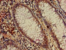 Immunohistochemistry of paraffin-embedded human colon cancer using CSB-PA013714LA01HU at dilution of 1:100