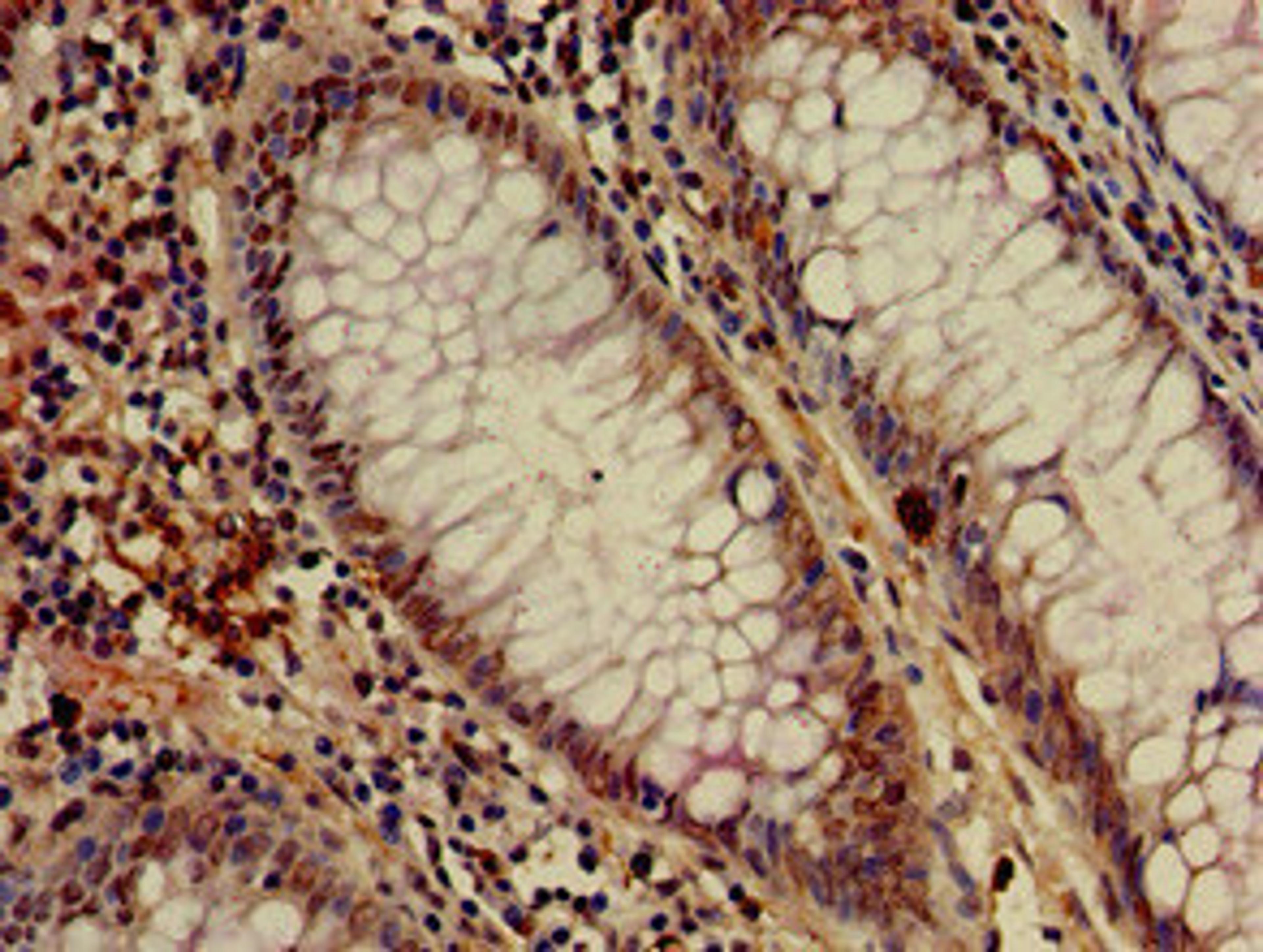 Immunohistochemistry of paraffin-embedded human colon cancer using CSB-PA013714LA01HU at dilution of 1:100